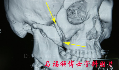 颧骨颧弓下垂CT