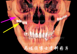 颧骨手术后下垂CT