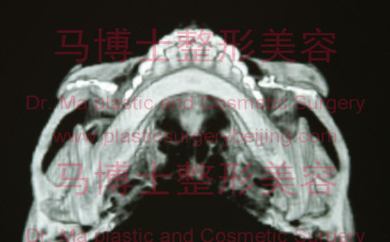 颧骨颧弓整形术后CT颧骨颧弓下垂内收