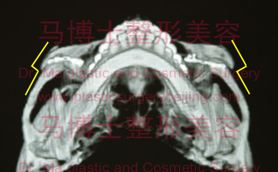 颧骨颧弓前端截骨术后三维CT片