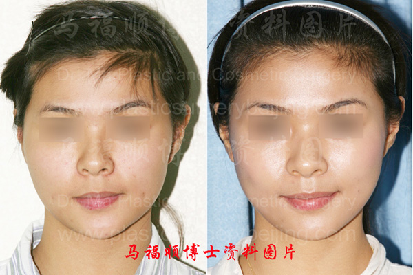 颧骨颧弓舒平术术前及术后正面