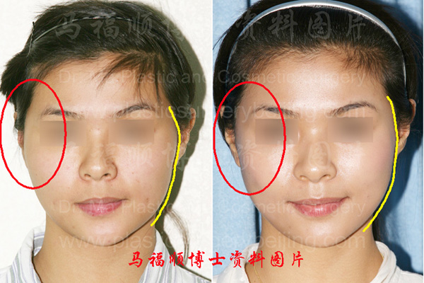颧骨颧弓舒平术对比照片解析