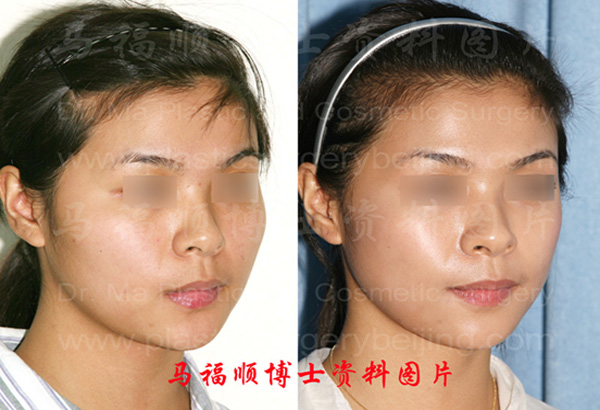 颧骨颧弓整形对比照片45度斜位