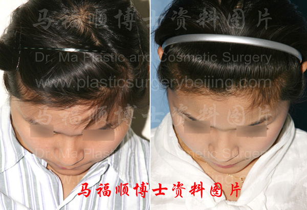 颧骨颧弓舒平术低头位对比照片