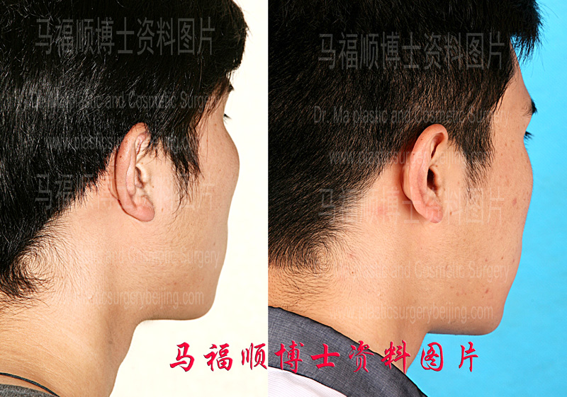 颧骨颧弓整形斜后位对比照片 颧骨颧弓整形斜后位对比照片