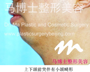 上下颌前突侧面像