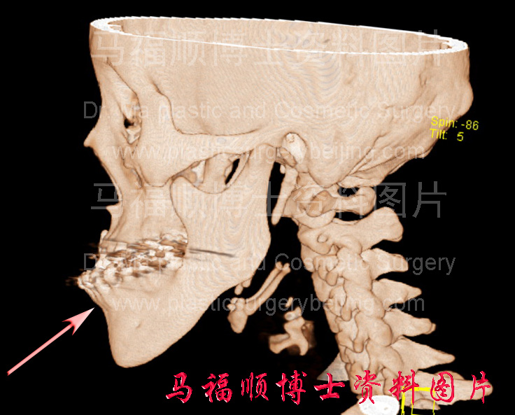 下牙弓前突之CT三维重建