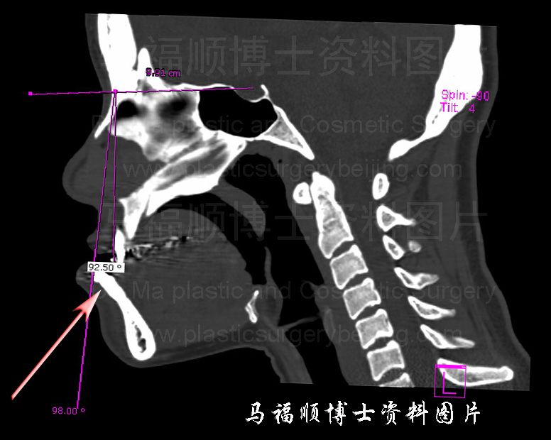 下牙弓前突之CT断层