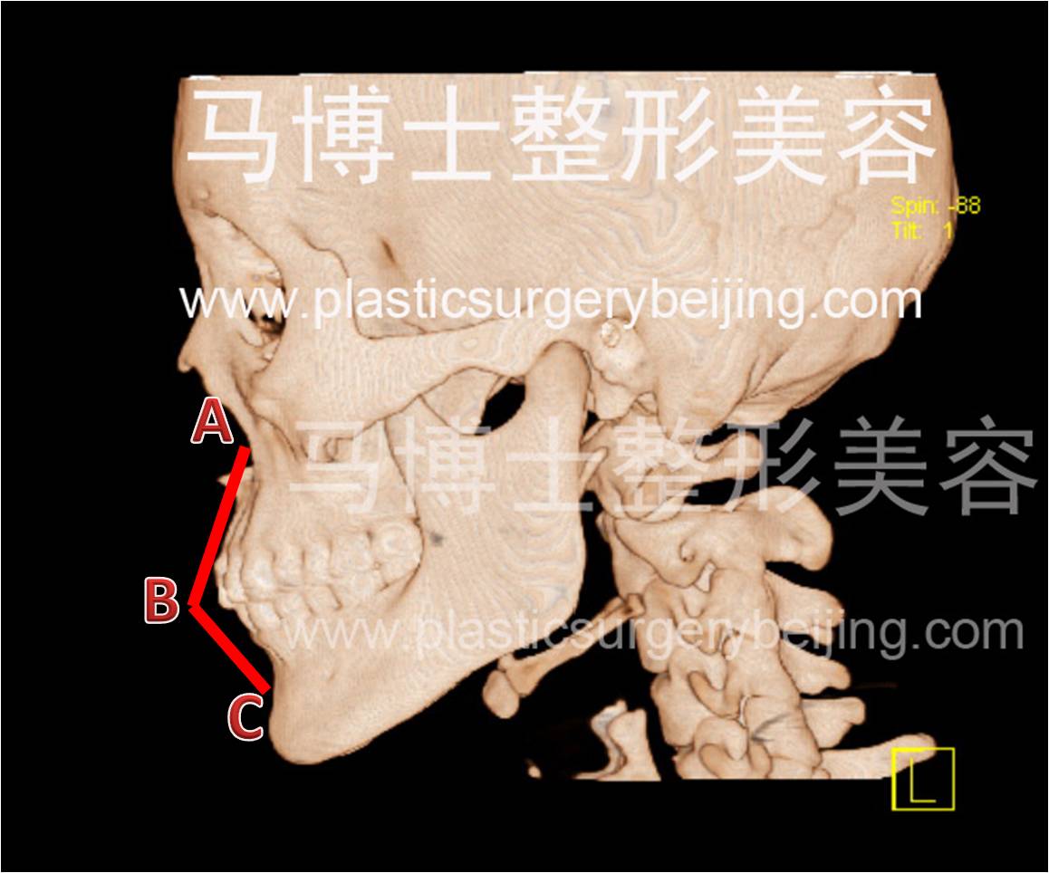 上下颌骨CT照片，上下颌突度基本正常