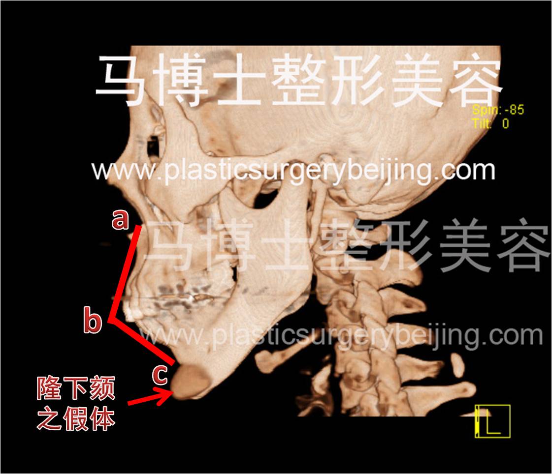 上下颌骨CT照片，上下颌过度前突