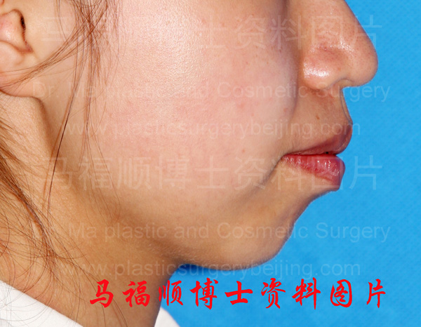 上下牙弓前突者照片