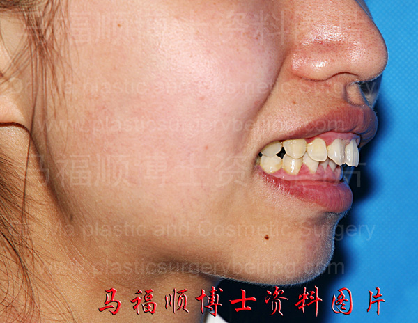 上下牙弓前突者开唇时照片