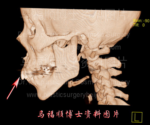 上下牙弓前突之CT三维重建