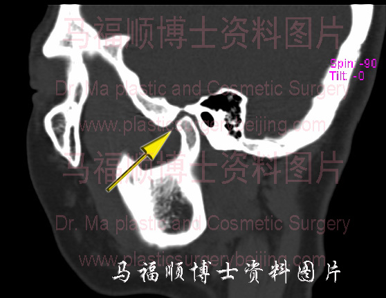 颞下颌关节矢状位