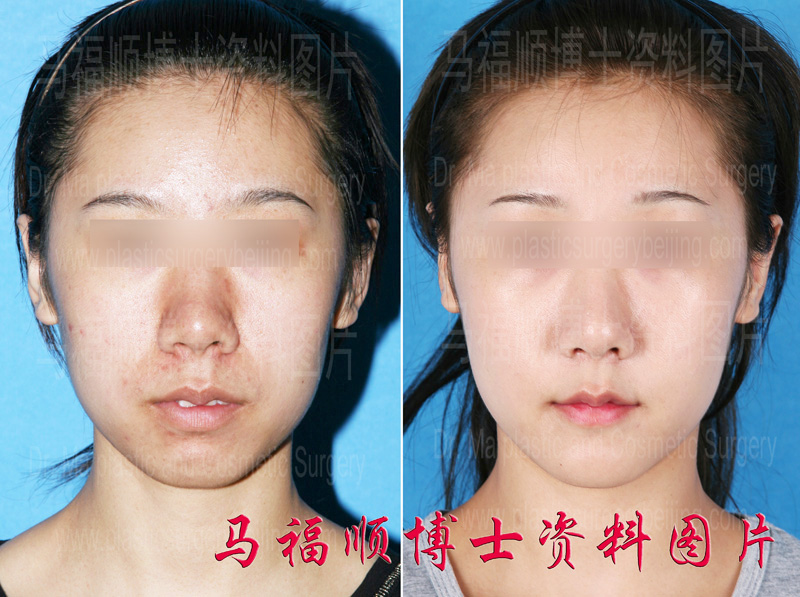 轻度龅牙整形前后正面