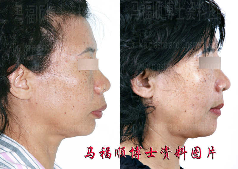 上下颌前突整形侧位