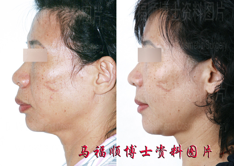 上颌前突整形侧面