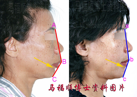 上颌前突整形分析