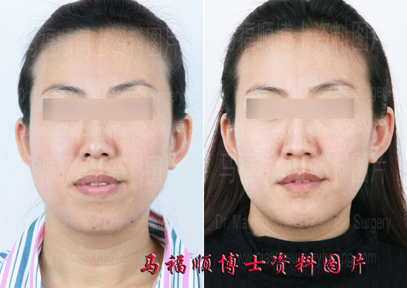 突嘴整形手术前后对比