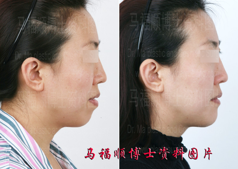 上下颌前突整形