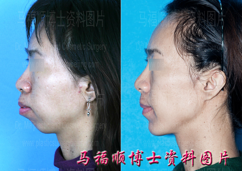 双颌整形手术照片侧面 双颌整形手术照片侧面