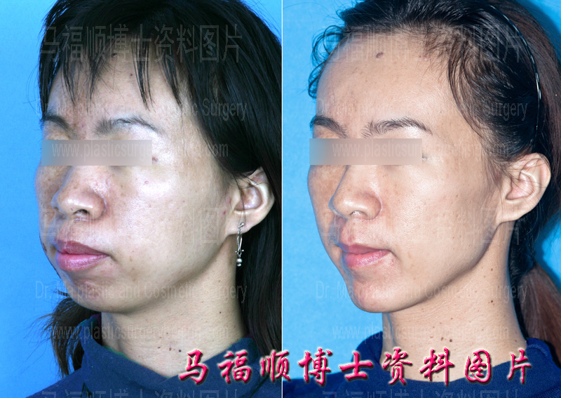 双颌前突整形斜位 双颌前突整形斜位