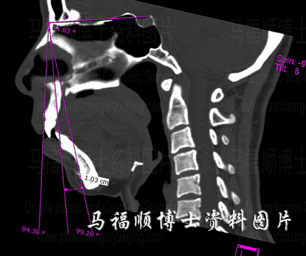 双颌前突CT片 双颌前突CT片