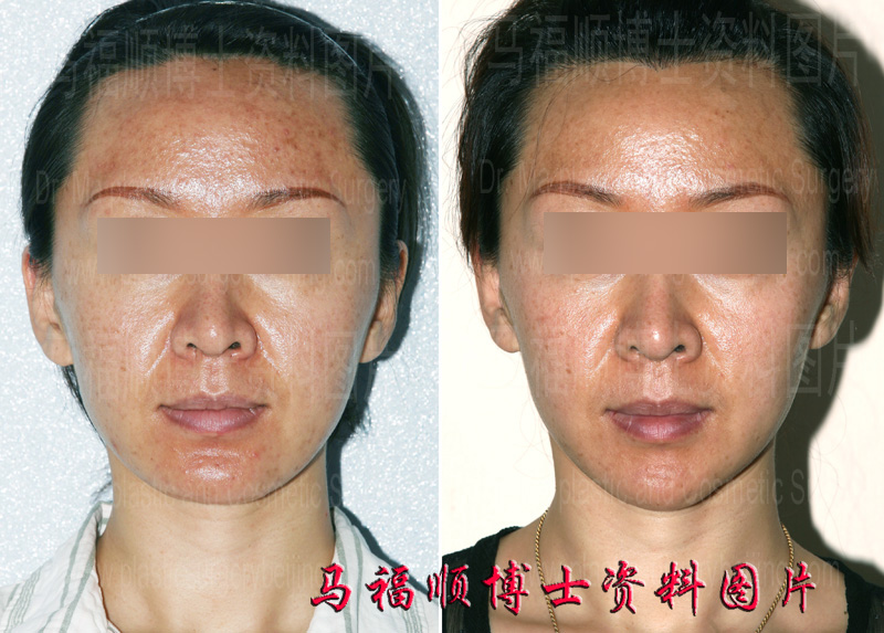 宽下巴缩窄颏前移