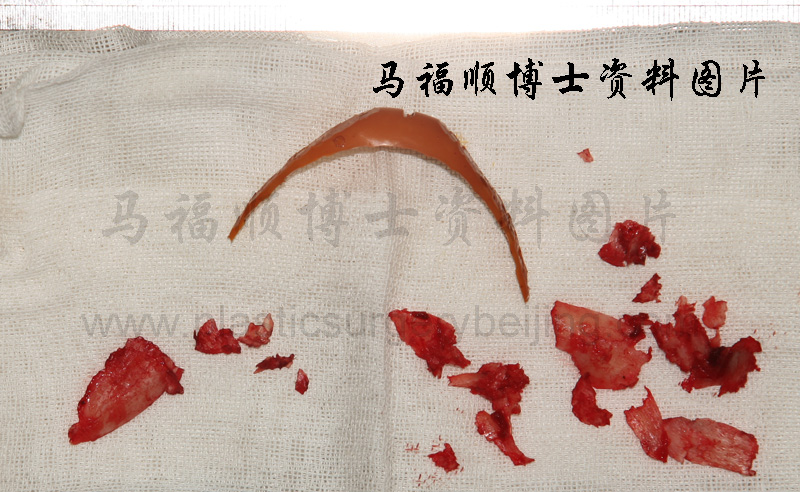 手术时取出的假体及骨骼