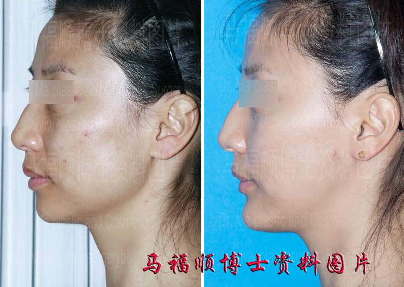 颏前移整形效果