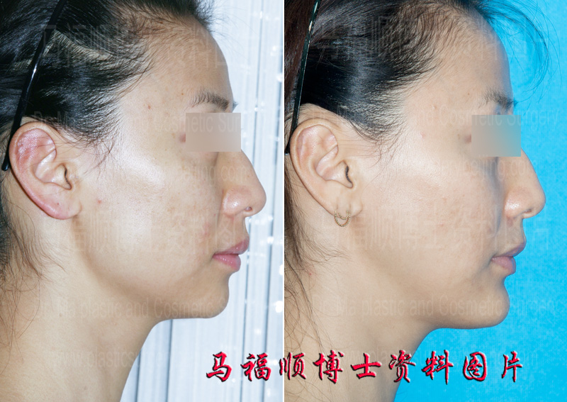 颏前移整形后的下巴颏