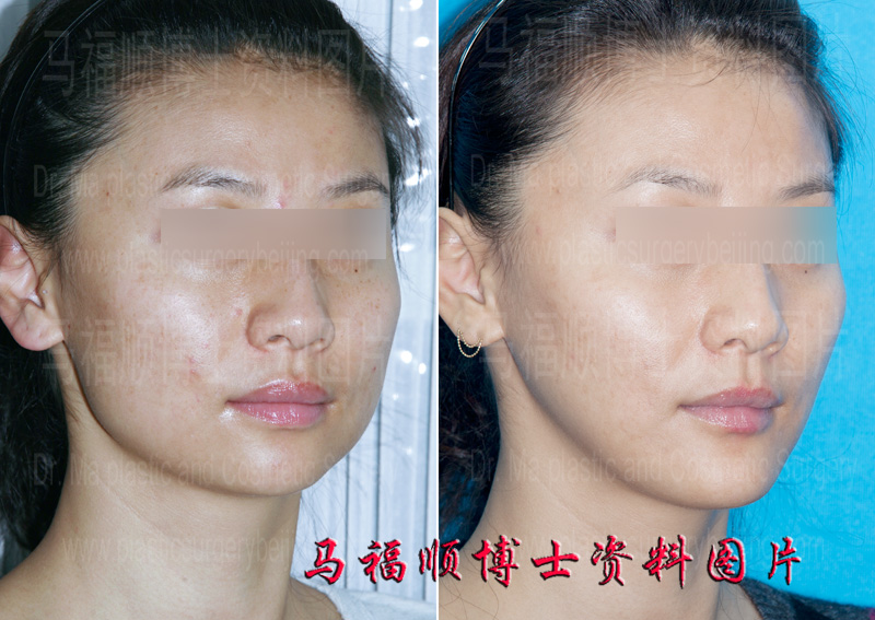 锥子脸整形前后对比