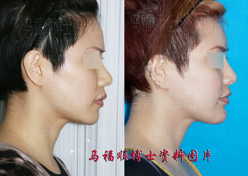 颏前移整形