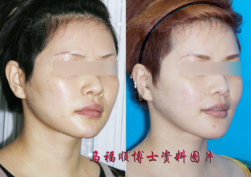 下巴假体取出颏前移整形