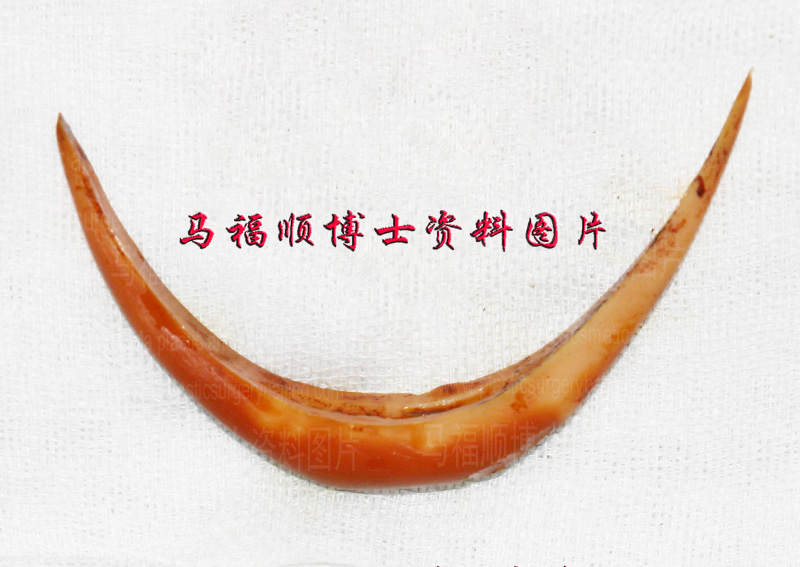 垫下巴用的假体