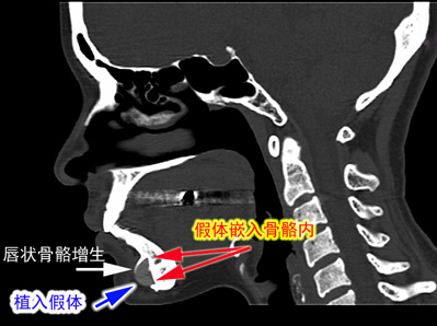 下巴假体CT断层