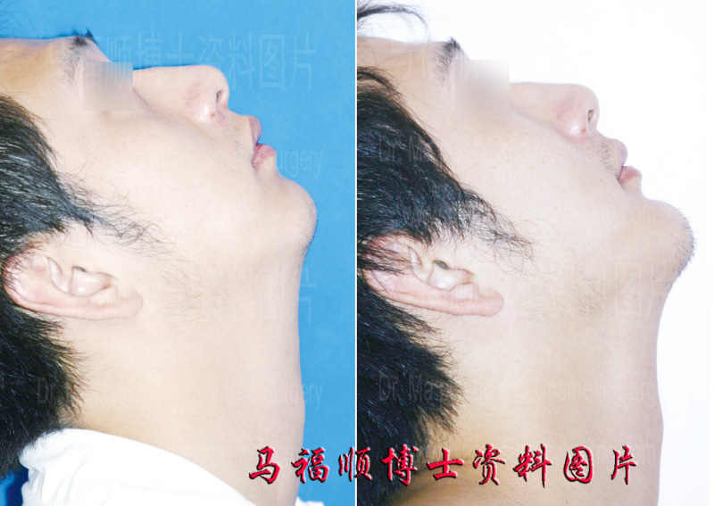 下颌水平截骨颏前移整形