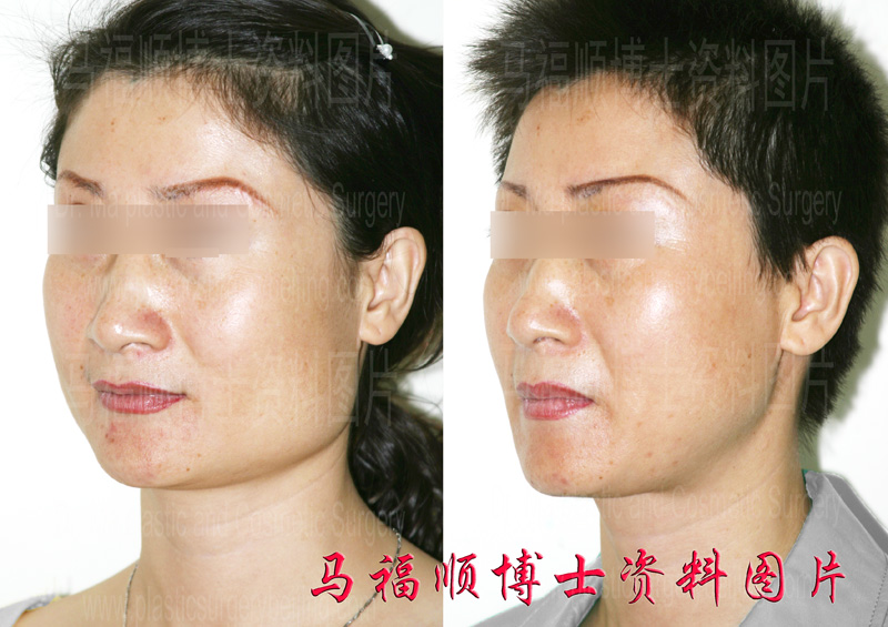 由字脸整形斜位对比照片