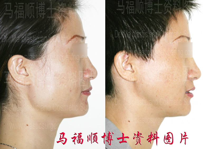 由字脸整形侧位图片