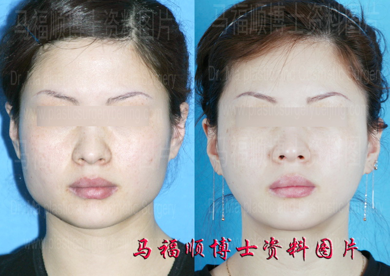 下颌角整形对比照片
