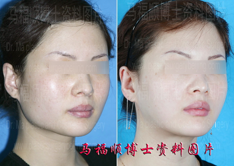 下颌角整形前后对比