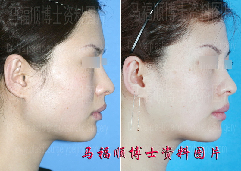 下颌角整形侧位