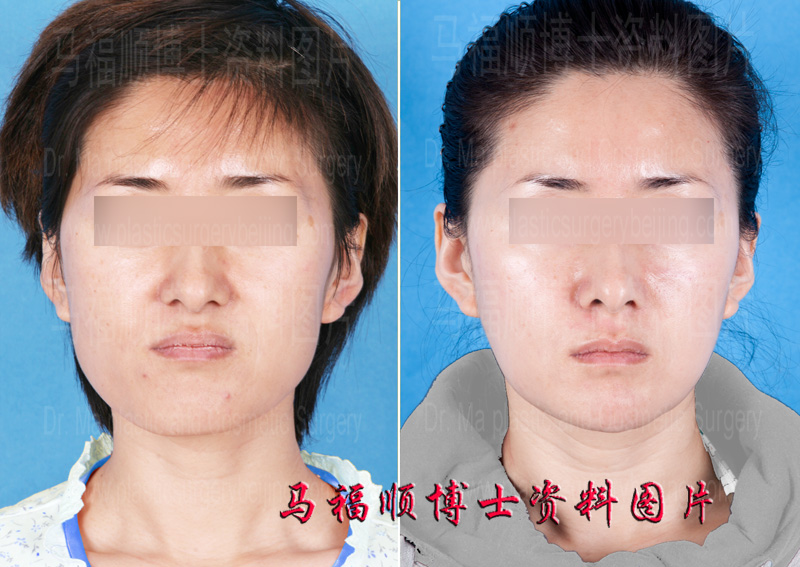 下颌骨整体缩小上颌骨前移