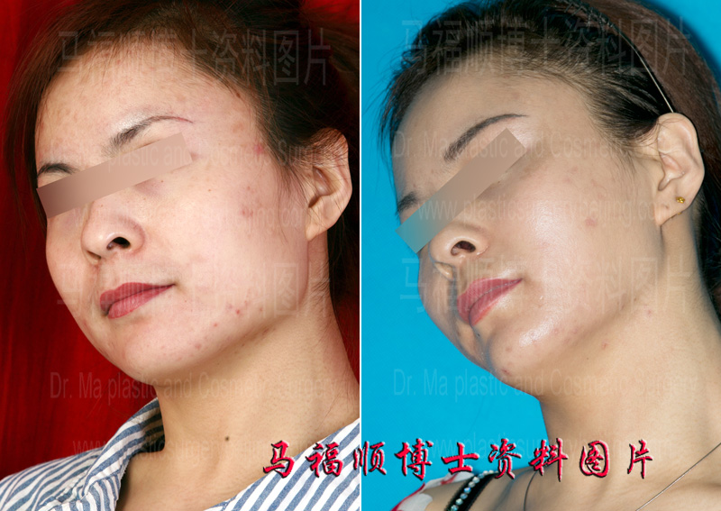 咬肌切除与瓜子脸