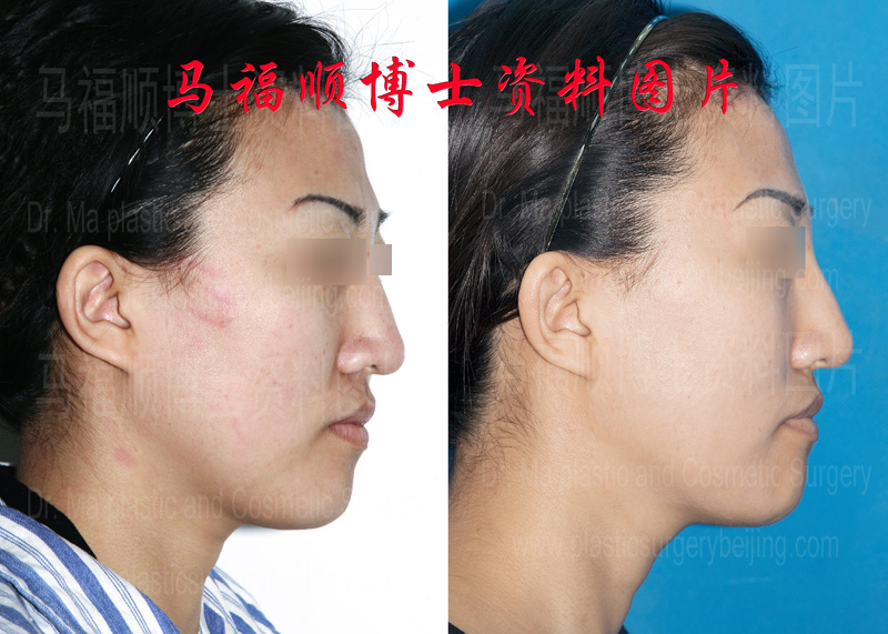 不对称下颌骨矫正侧位