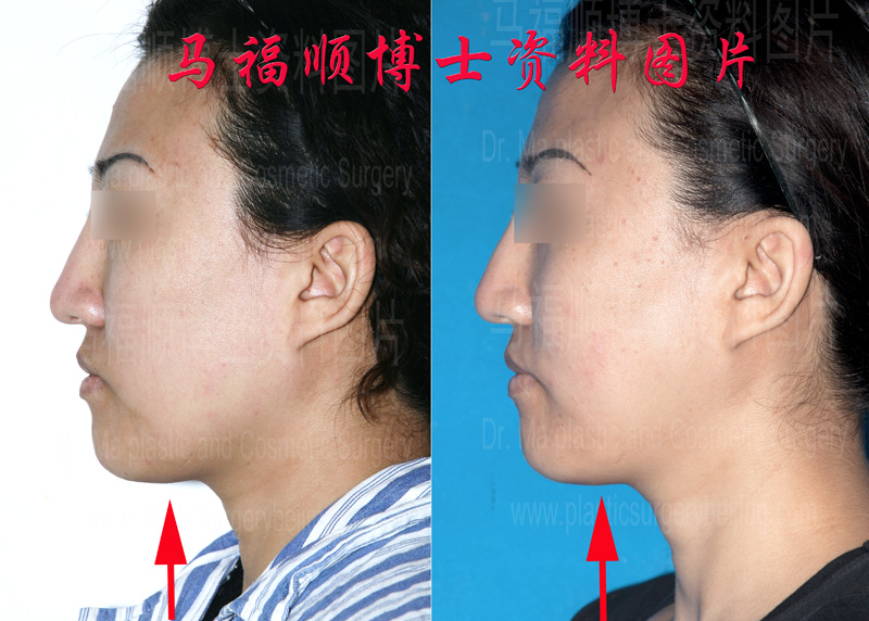 不对称下颌骨矫正及下颌骨缩小侧位