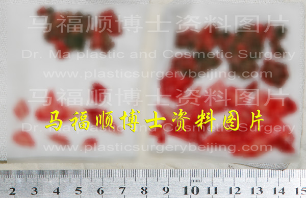 不对称下颌骨整形切下的肌肉及骨骼