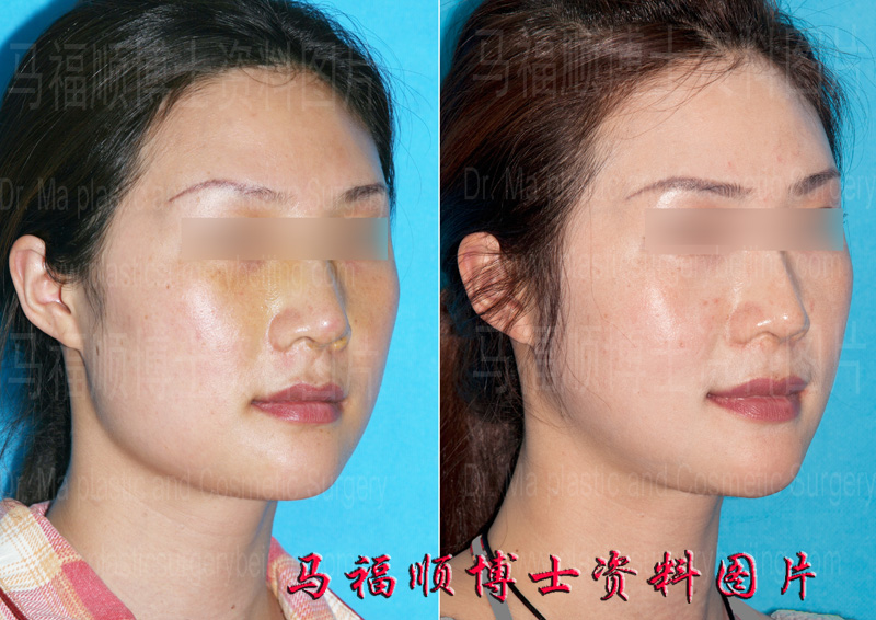 不对称方脸整形