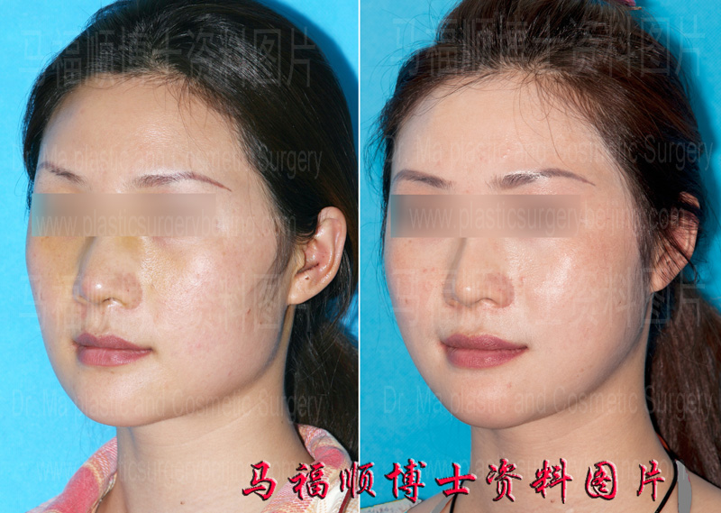 方脸变鸭蛋脸斜位