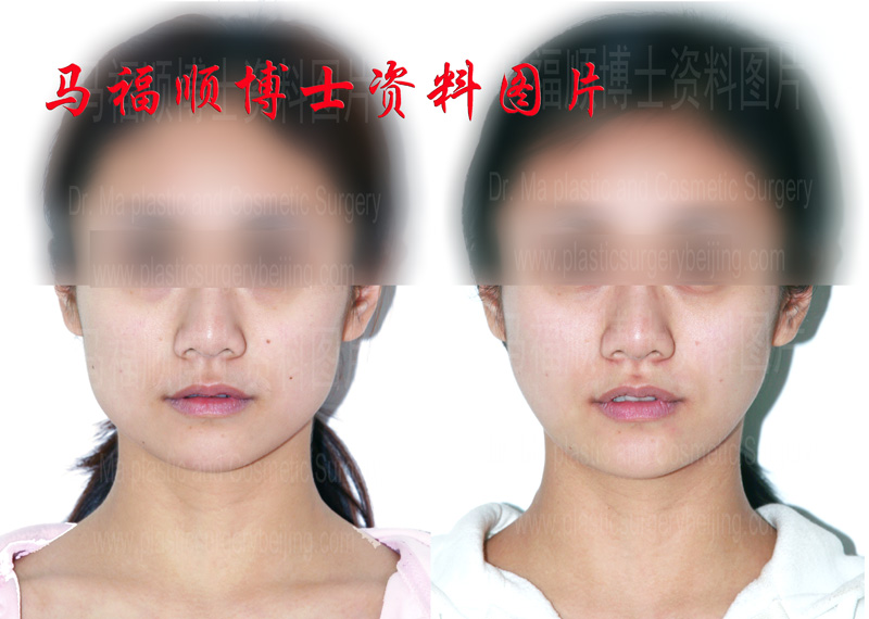 咬肌部分切除对比照片 咬肌部分切除对比照片